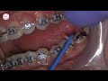 Orthodontic rubber bands placement by dr amr asker