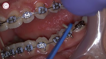 Orthodontic Rubber bands placement by Dr. Amr Asker