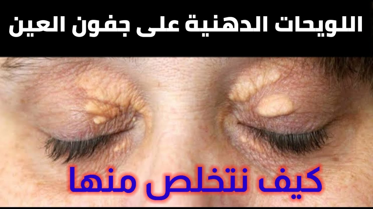 اللويحات والترسبات الدهنية على جفون العين..كيف نمنع حدوثها