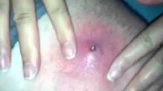 Ingrown Hair Results in Huge Pimple Pop - Disgusting!