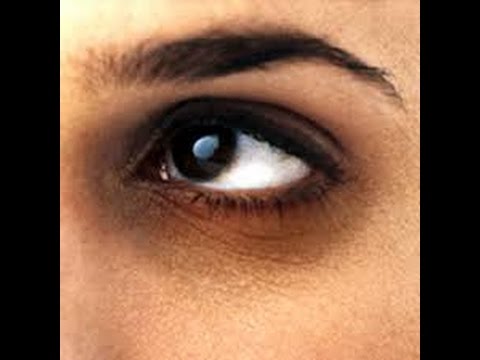 سواد حول العين يعني ماذا يعني جفاف الجلد؟