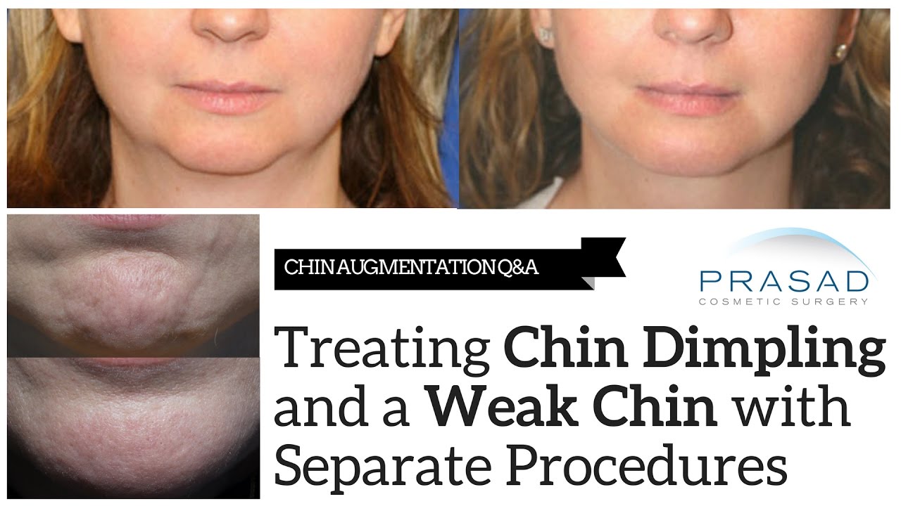 How a Weak Chin, and Orange Peel Skin of the Chin are Treated with Separate Procedures