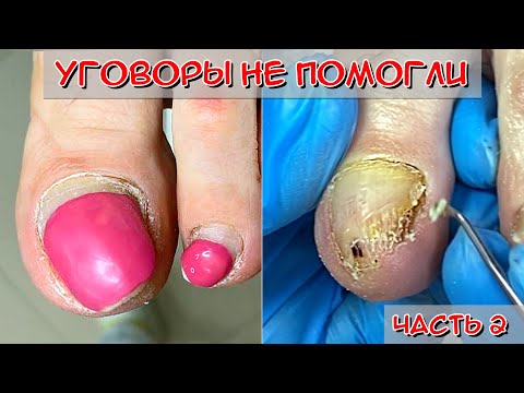 Онихолизис ногтей на ногах / Кератоз ногтей (Часть 2)