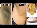 Baking soda for underarm whitening  dark underarms home remedy