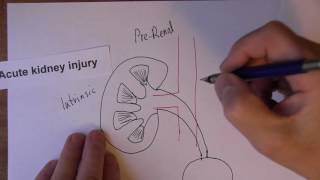 Acute Kidney Injury 1, Pre Renal Causes of AKI