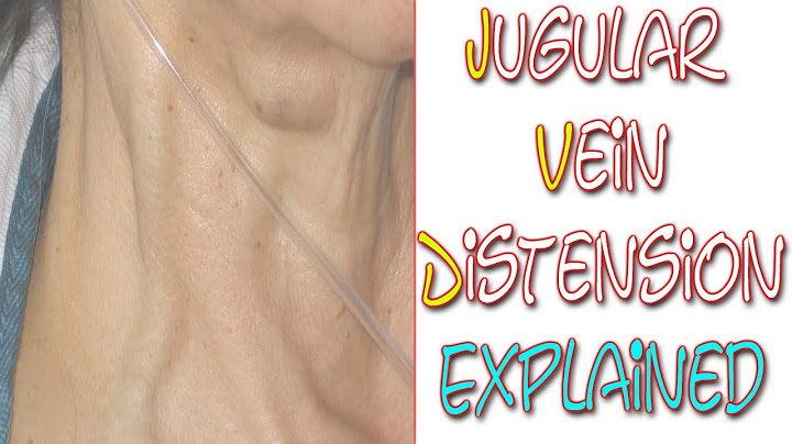 Pathophysiology of jugular vein distention in heart failure