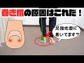 巻き爪の原因はコレだ！足指を鍛えよう！