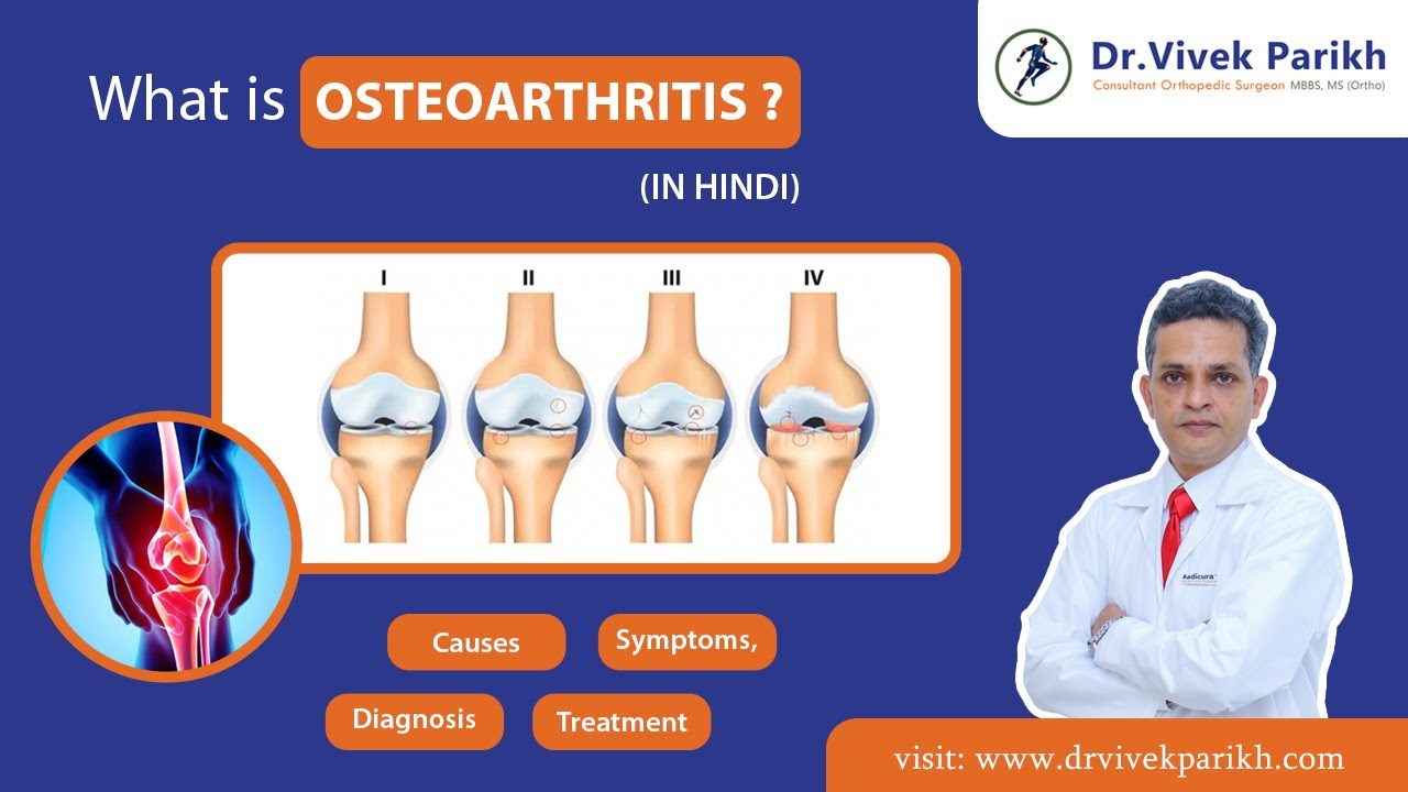 WHAT IS OSTEOARTHRITIS (IN HINDI) Dr. Vivek Parikh (Aadicura