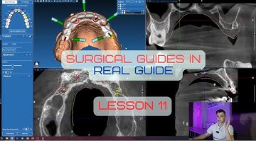 Surgical guides in RealGuide Tutorial. Lesson 11. Stackable guides, with All on 4. Part 1