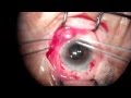 Экстракапсулярная экстракция катаракты с имплантацией ИОЛ