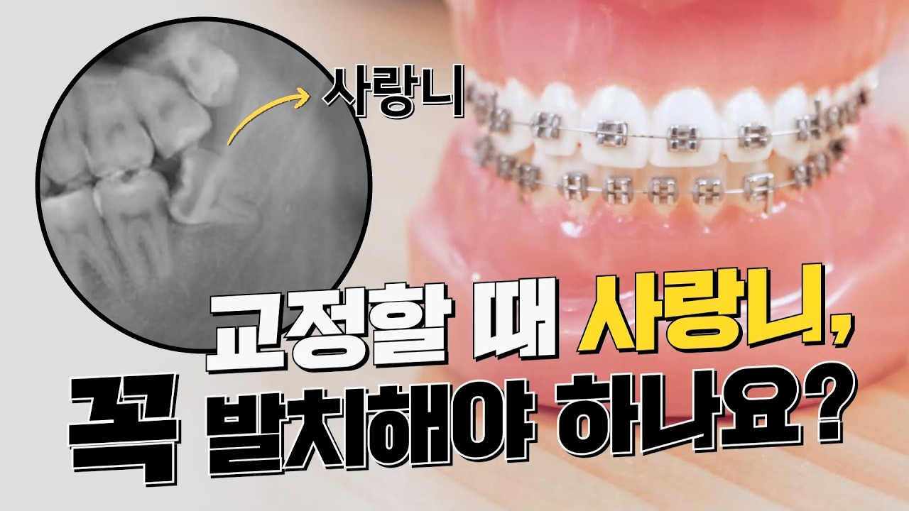 교정할 때 사랑니, 꼭 발치해야 하나요?