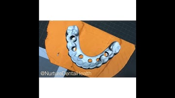 Immediate Load Implant Fixed Temporary Bridge