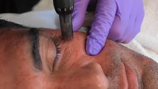 Rodiney Santiago Sees Dr. Kian for Sun Damage Treatment | Microneedling with PRF