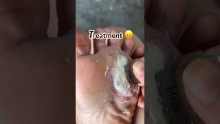 Mera per khrab ho gaya 😢 || #FootCare 🦶 #CornTreatment 😖 #AgainAndAgain 🔄 #viralvideo #minivlog