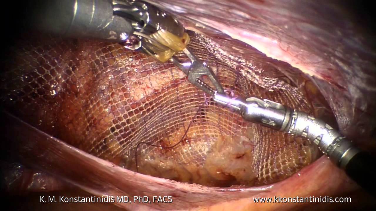 Robotic TAPP Sports Hernia Repair with mesh both sides