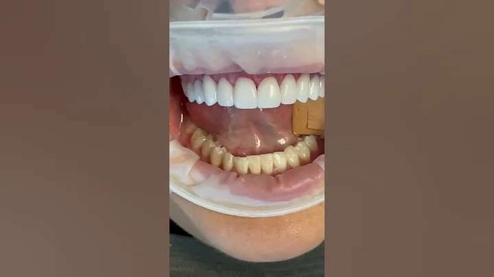 Porcelain Veneers by Dr. Tejas Patel