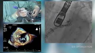 Asvide: Cardioband