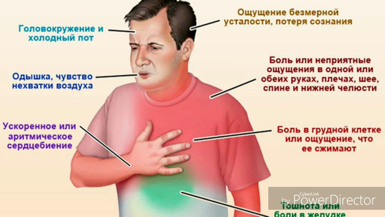 Потливость у мужчин после 60 лет. Инфаркт миокарда симптомы. Инфаркт миокарда симпт. Признаки инфарктамиокардп.