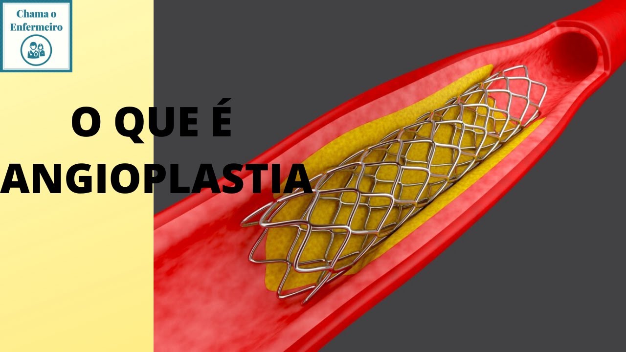 O que é Angioplastia parte 1 YouTube O que é Angioplastia parte 1 YouTube