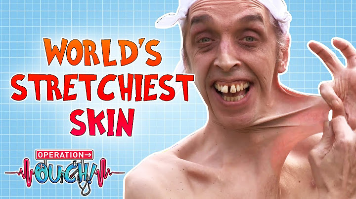 World's Stretchiest Skin | Full Episode | Operation Ouch
