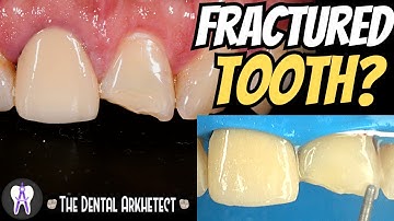 Quick Restoration of A Fractured Tooth #C57 #4k