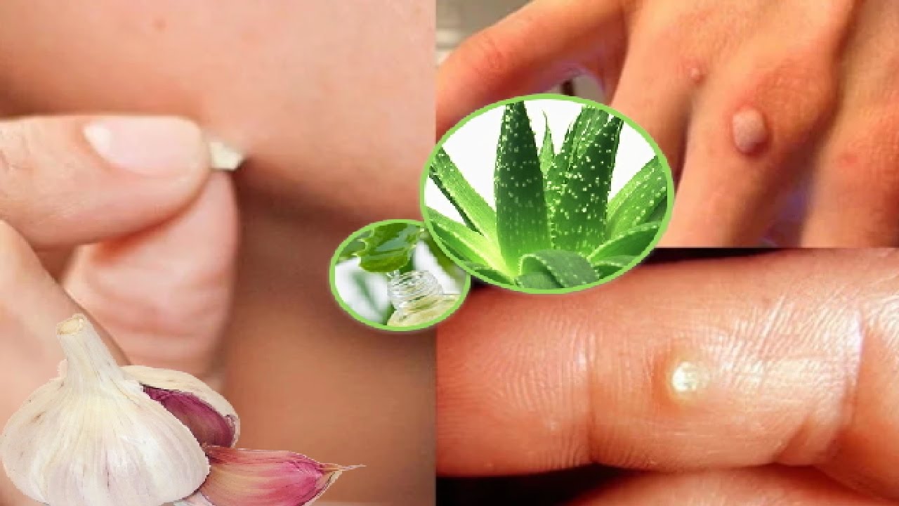 Remedios Caseros para Eliminar las Verrugas de Forma Natural YouTube