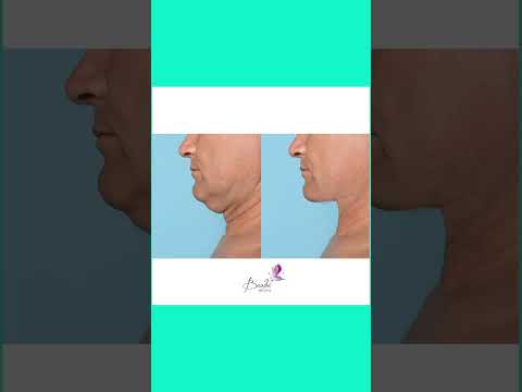 Adelgazamiento facial - casos de éxito