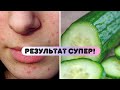 СУПЕР СРЕДСТВО / КАК ИЗБАВИТЬСЯ ОТ ПРЫЩЕЙ 😱😱  БЫСТРО в ДОМАШНИХ Условиях / ЛАЙФХАК.