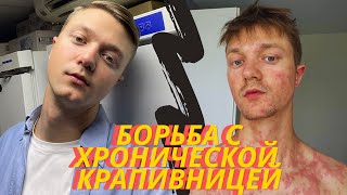видео: ХРОНИЧЕСКАЯ КРАПИВНИЦА: МОЯ ИСТОРИЯ СТРАДАНИЙ И ЛЕЧЕНИЯ 😰❤️🩹💉 картинка: ХРОНИЧЕСКАЯ КРАПИВНИЦА: МОЯ ИСТОРИЯ СТРАДАНИЙ И ЛЕЧЕНИЯ 😰❤️🩹💉