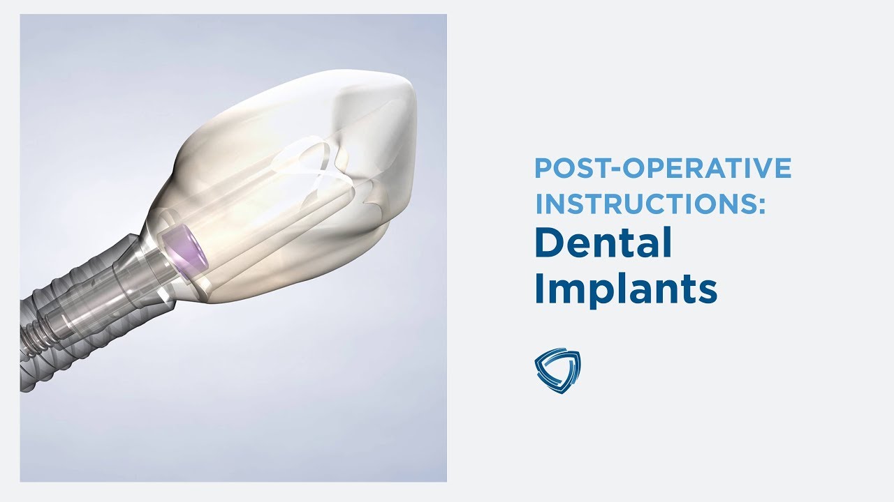 Post-Operative Instructions: Dental Implants at Columbia Basin Oral &  Maxillofacial Surgeons