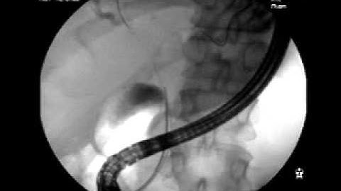 Proximal Cholangiocarcinoma