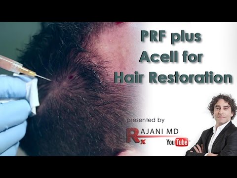 PRF plus Acell for Hair Restoration-Dr Rajani - YouTube