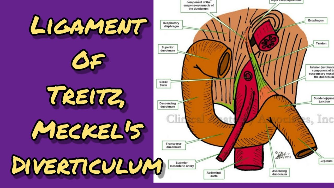 Ligament of Treitz , Meckel's diverticulum YouTube