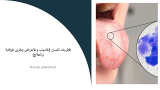 فطريات اللسان (والاسباب والاعراض وطرق الوقايه والعلاج )