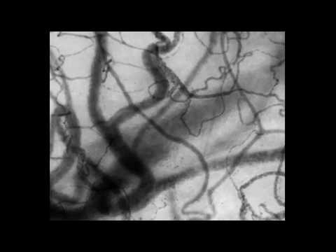 Preserved Microcirculation