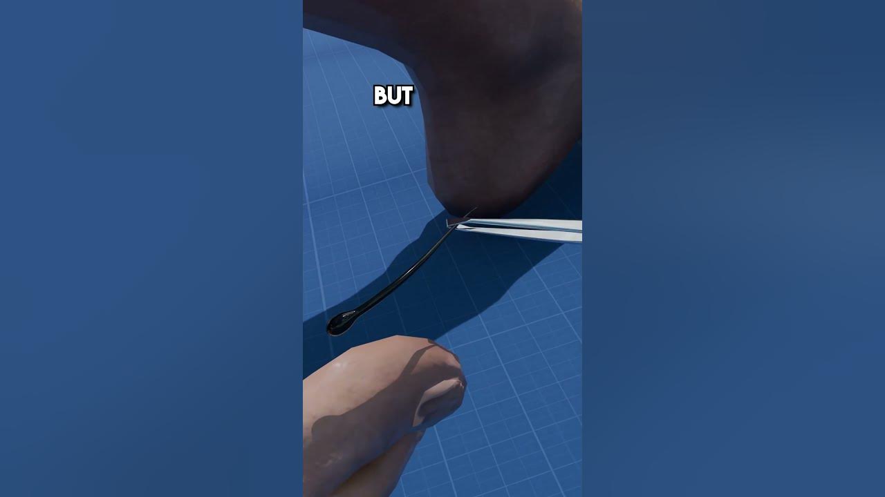 How Hair Splinters Get STUCK! 😱