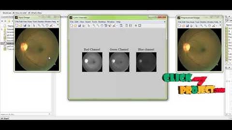 Final Year Projects 2015 | DETECTION OF EXUDATES IN COLOR FUNDUS IMAGE