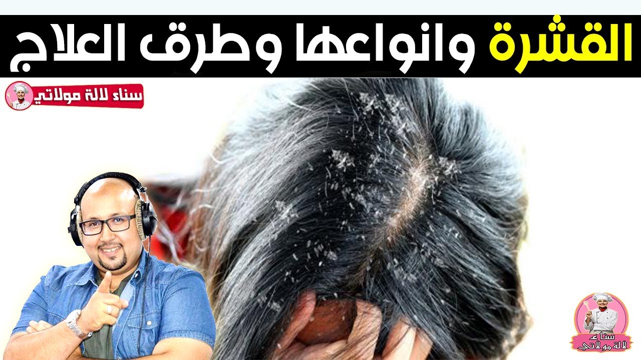 القشره وانواعها وطريقة التخلص منها مع الدكتور عماد ميزاب imad mizab