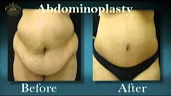 Orlando Tummy Tuck