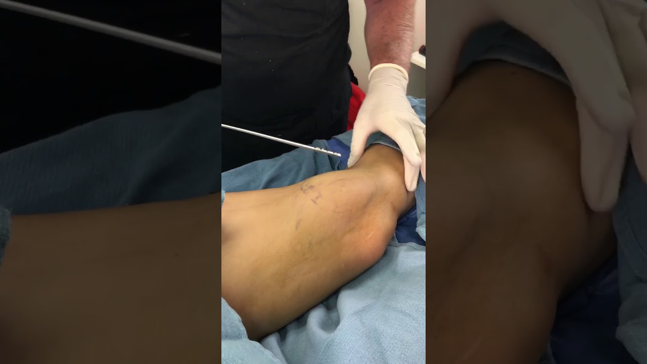 Liposuction Knees Awake Must See Dr Thomas Barnes Newport