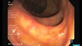 Normal Adult Colonic Anatomy in Colonoscopy