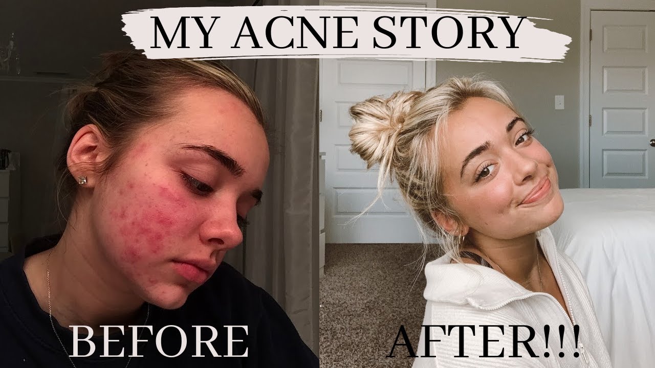 MY BIGGEST INSECURITY my acne story YouTube