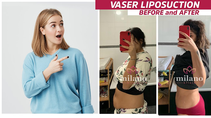 Vaser lipo 360 before and after