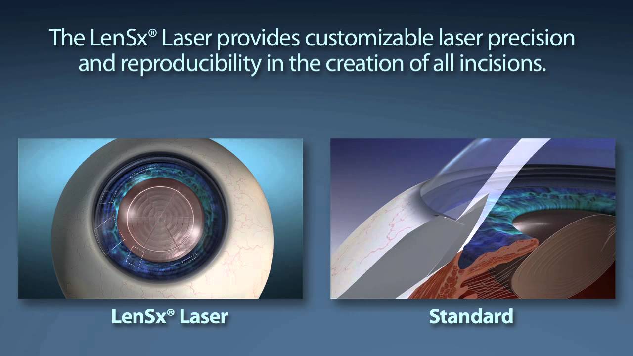 Femtosecond Laser Cataract Surgery YouTube