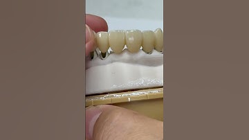 Bridge from 4 implants!