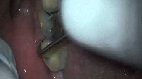 Refining a core backup using a Seiler Microscope By Elpis Dental