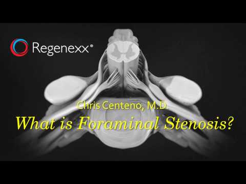 What is Foraminal Stenosis?