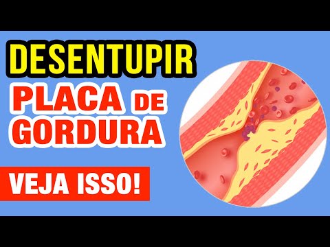 Vídeo: 3 maneiras de limpar artérias obstruídas naturalmente