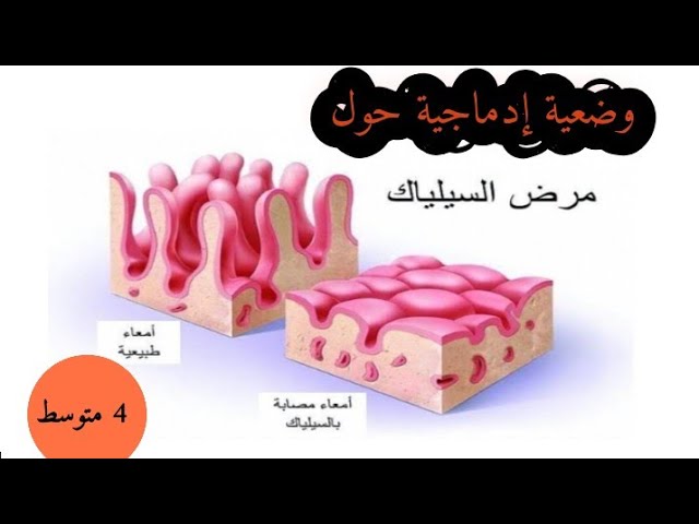 وضعية إدماجية مقترحة حول مرض السيلياك 4 متوسط
