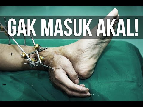 5 OPERASI ORGAN PALING KONTROVERSIAL DI DUNIA